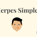 Herpes Simplex