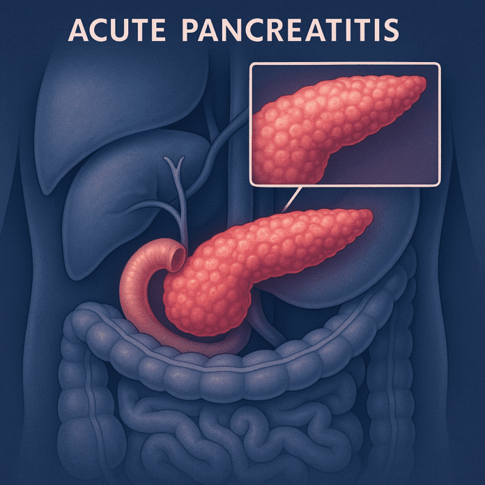 Acute Pancreatitis 