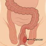 Anal Cancer 