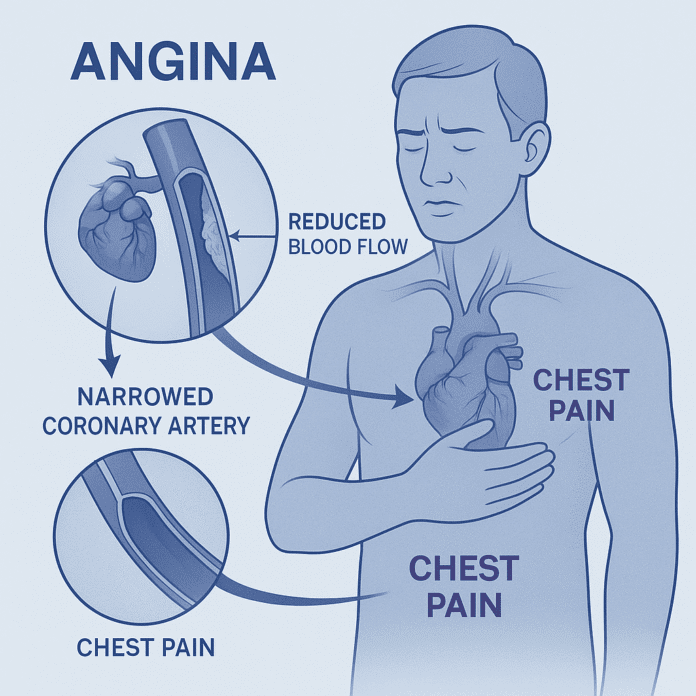 Angina 