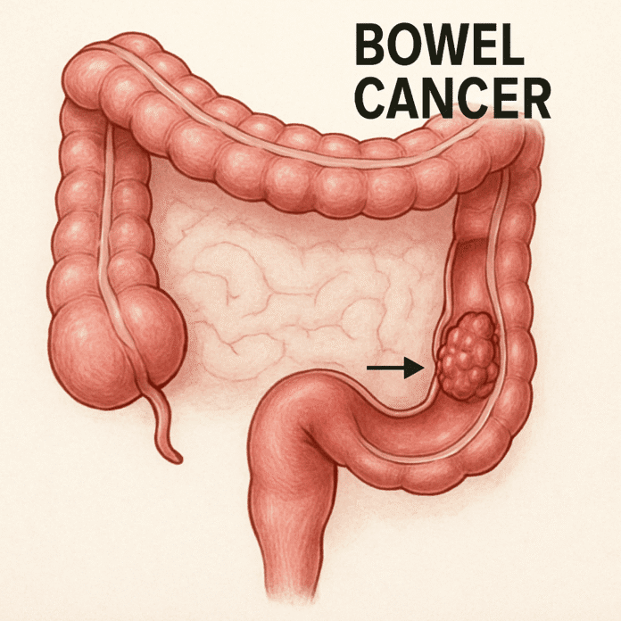 Bowel Cancer